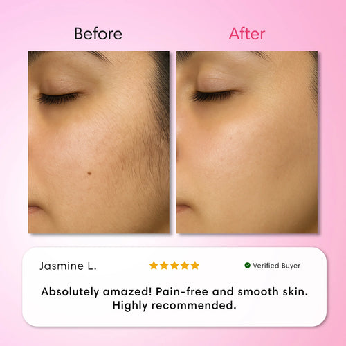 Hair Removal Trilogy Kit