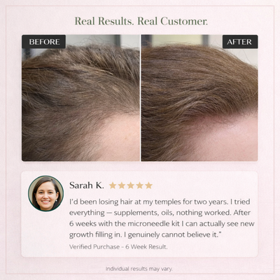 Cazoba™ PCOS Hair Regrowth System