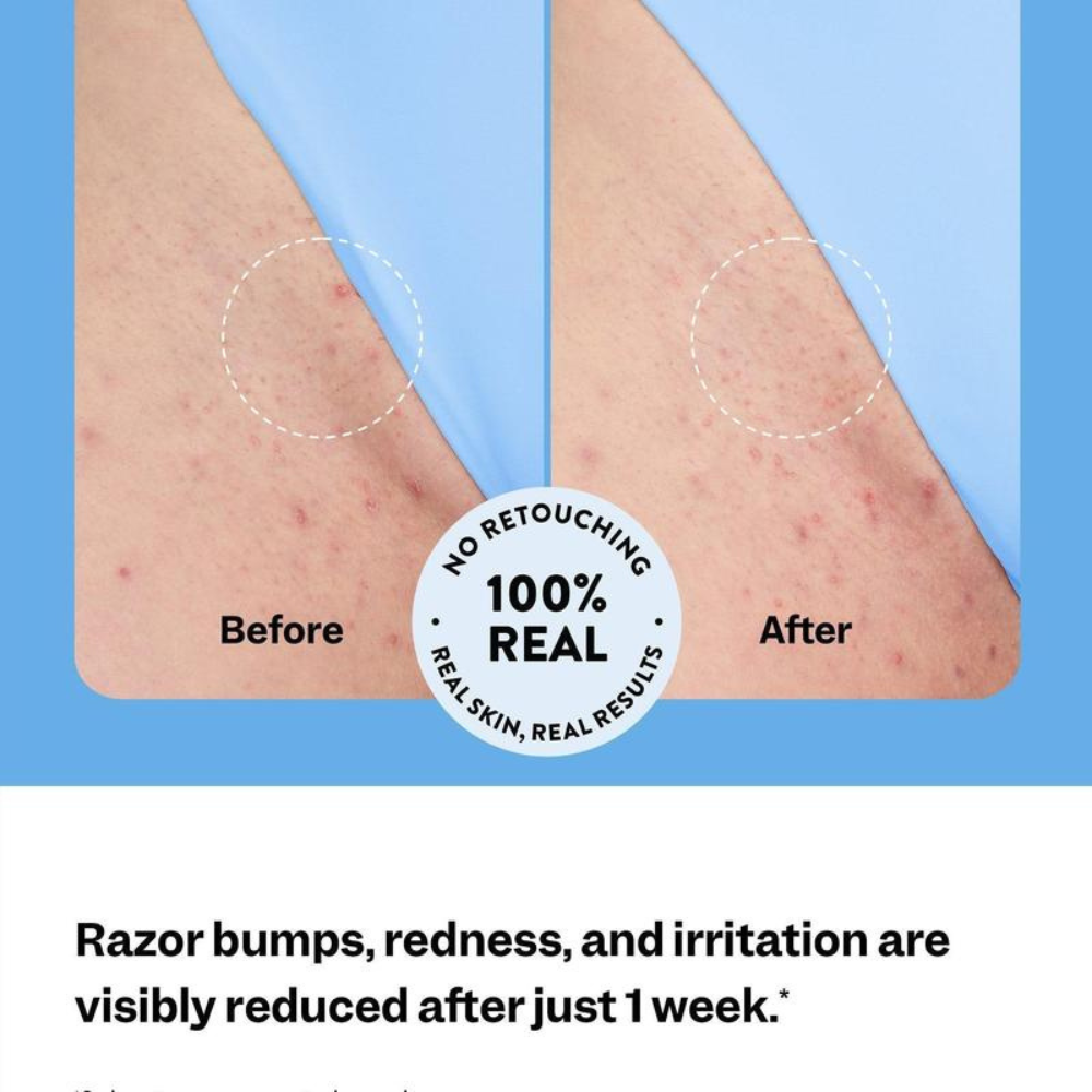 Smoothing Solution Roller Treatment