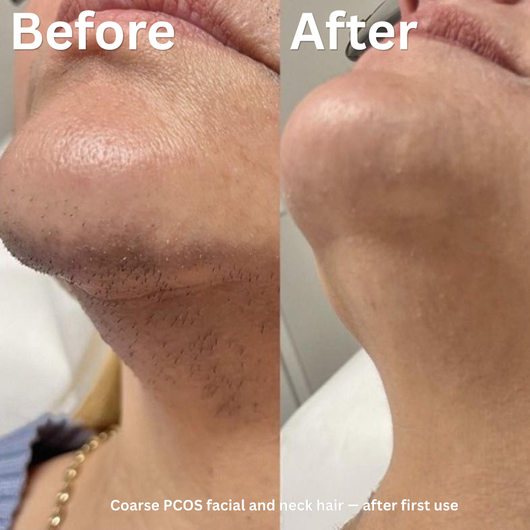 Hair Removal Trilogy Kit